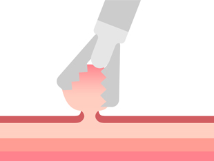 ポリペクトミー2