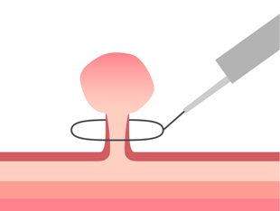 ポリペクトミー1