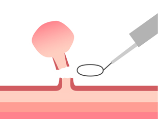 ポリペクトミー2